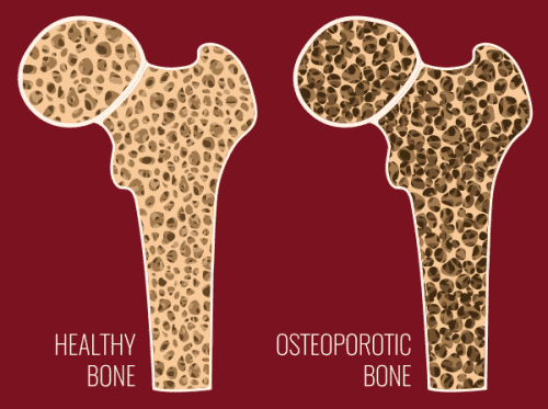 Healthy bone vs osteoporotic bone infographic illustrating the need to see one of our endocrinologists in Idaho Falls or Pocatello.